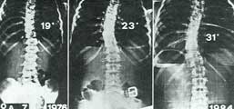 Fig. 10– Scoliosi congenita non trattata: dimostra col tempo modeste attitudini evolutive.