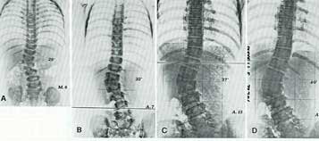 Fig. 12 - Scoliosi lombare da emispondilo: da 28° a 8 mesi, 32° a 7 anni, 37° a 13 anni, 40° a 15 anni.