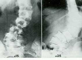 Fig. 13 - Scoliosi congenita da emivertebra segmentata e non incarcerata: gravissima evoluzione oltre il termine della maturazione ossea.