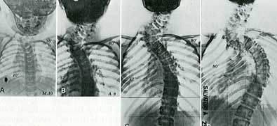 Fig. 14 - Scoliosi da barra non segmentata associata ad emispondili controlaterali al passaggio cervico-dorsale. La curva passa da 38° a 10 mesi, 80° a 8 anni, 90° a 14 anni, 93° a 18 anni.