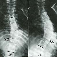 Fig. 15 - Scoliosi congenita da barra non segmentata: evoluzione da 2 a 4 anni.