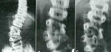 Fig. 17 - Scoliosi congenita lombare Dx di 54° come si vede nella radiografia standard in AP (A). La stratigrafia consente di precisare le anomalie vertebrali presenti: in un taglio anteriore (B) ben si evidenzia l’emivertebra L4, mentre una sezione posteriore (C) documenta l’assenza degli emiarchi posteriori di Dx di L3 e di L5.