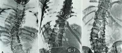 Fig. 18 - Valutazione prognostica basata sull’aspetto radiografico dell’anomalia (vedi testo). In A sensibile differenza nella somma dei valori tra concavità e convessità con prognosi di notevole aggravamento. In B la differenza è invece ridotta e modesta sarà la prognosi di aggravamento come confermato in C ad oltre 7 anni di distanza.